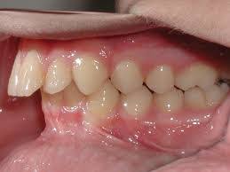 Not sure what sets you apart from other candidates? What Is The Difference Between Crossbites Overbites And Underbites