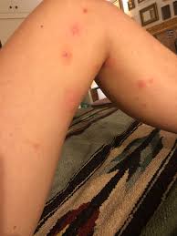 Image result for bedbug bites look like