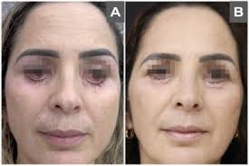 Integrated management of facial harmonization complications using ozone  therapy: A description of 2 cases