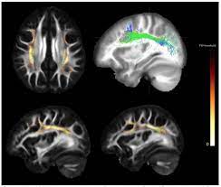 The condition may develop slowly. Study Finds Brain Defects In People With A Genetic Risk For Schizophrenia Ucla