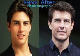Tom Cruise Plastic Surgery Plastic Surgery Celebrity Plastic Surgery Nose Job