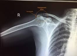 Image result for Frozen Shoulder