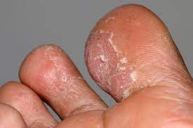 All You Need To Know About Athlete S Foot Feet Theclinic