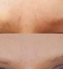 How to get rid of lines between eyebrows. How To Get Rid Of Frown Lines Between Brows With A Dermaroller