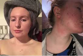 Topical creams many chemical burns cause inflammation, and to reduce this; Superdrug Investigates Mum S Claim Acne Gel Left Her With Chemical Burns Deadline News