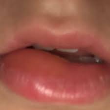 Bei geschwollenen unterlippen handelt es sich um ein symptom, das sich zunächst durch eine abnormale erscheinung der unteren lippe bemerkbar macht. Lippe Stark Angeschwollen Unten Rechts Kein Schmerz Muckenstich Gesundheit Und Medizin Stich Geschwollen
