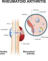Image result for Rheumatoid Factor
