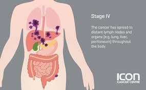 Either of these cancers is called colorectal cancer. Colorectal Cancer Signs Symtomps Icon Centre Singapore