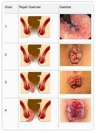 Maybe you would like to learn more about one of these? Ubat Rawat Buasir Berkesan Hemocare Dan Hemooil