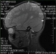 (been put on keppra (levetiracetam) for seizures). Cat Mri And Ultrasound Engineering And Technology History Wiki