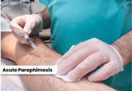 Image result for paraphimosis