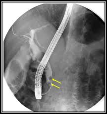 Image result for Choledocholithiasis