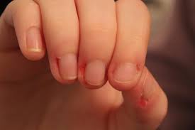 Skin Picking Disorder (Excoriation Disorder): Causes | Treatments