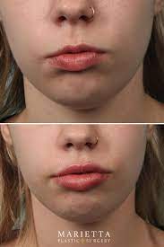 Collagen and fat are lost as our bodies age, which leads to thickness and sagging of the face, and the lips are no exception. Restylane Kysse Before After Injectables Fillers Dermal Fillers Restylane