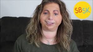 Fond du Lac's Sarah Freund talks about life with Treacher Collins Syndrome 