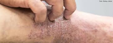 Image result for Atopic Patient