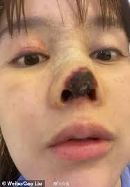 Maybe you would like to learn more about one of these? Chinese Actress Reveals The Tip Of Her Nose Has Rotted Away Following Botched Cosmetic Surgery Daily Mail Online