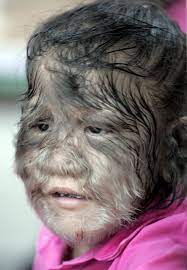 Petrus gonsalvus, the hairy man. Kids Get Werewolf Syndrome From Taking Dodgy Medicine In Spain S Costa Del Sol World News Mirror Online