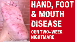 Have you wondered why hand, foot, and mouth disease often goes by another name? Hand Foot And Mouth Disease Documentary Our Two Week Nightmare