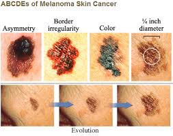 Hearing the doctor tell you that you've got cancer is undoubtedly one of the worst things you may experience. What Do Our Moles Tell Us Cape Gazette