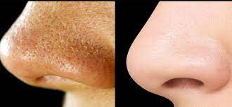 Mitesser Oder Auch Komedonen Sind Kleine Schwarze Punkte Die Uberwiegend An Der Stirn Der Nase Und Dem Vaseline Beauty Tips Beauty Hacks Deutsch Blackheads