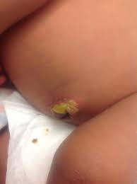 308 likes · 7 talking about this. A Herpes Type 1 Skin Infection In A Newborn The Bmj