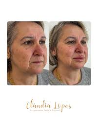 ✨ Que boca é essa, Brasil? 😍💋 Antes e depois daquele preenchimento labial  que é pura perfeição! Resultado natural, volume na medida certa e  autoestima lá no alto. Passe para o lado