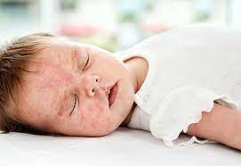 Scharlach Die Unterschatzte Kinderkrankheit Gesund Co At