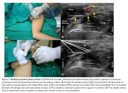 Image result for Axillary Nerve Block