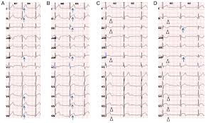 Myocarditis is an inflammatory disease of the myocardium that may present with sudden cardiac death, symptoms mimicking myocardial infarction, heart rhythm and conduction disorders, and heart failure. Role Of Electrocardiograms In Assessment Of Severity And Analysis Of The Characteristics Of St Elevation In Acute Myocarditis A Two Centre Study