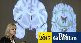There is no special care required after an mri. New Images Show Aaron Hernandez Suffered From Extreme Case Of Cte Nfl The Guardian