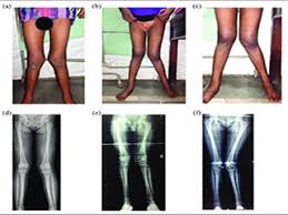 Image result for Genu Varum