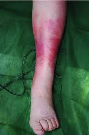 Haufige Bakterielle Infektionen Der Haut Und Weichgewebe Klinik Diagnostik Und Therapie Sunderkotter 2015 Jddg Journal Der Deutschen Dermatologischen Gesellschaft Wiley Online Library