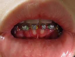 Herpes is separated into two types: Herpetic Gingivostomatitis Wikipedia