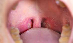Throat cancer that originates in the tonsil glands can cause swelling in the neck region that is also evident in the earliest stages. Tonsillitis Symptoms Signs Of Virus Infection Include White Spots In Throat Express Co Uk