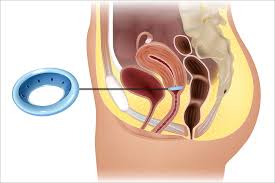 Image result for Pessary