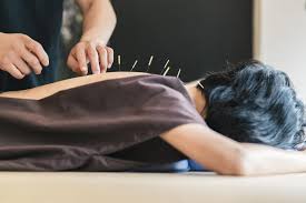 Image result for Acupuncture
