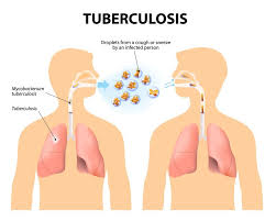 Tuberculosis Guide Causes Symptoms And Treatment Options
