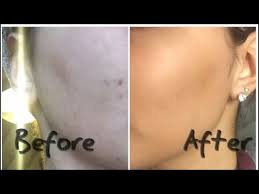 Comment Lutter Contre L Acne Et Les Taches Brunes L Huile De Nigelle Youtube