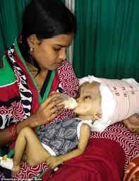 La plus grosse t?te du monde. Photo Cet Enfant A La Plus Grosse Tete Du Monde A Cause D Une Maladie Une Pomme Par Jour