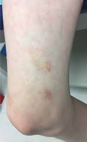 Purpura means that the illness produces a red or purple rash that is caused by bleeding under the skin. A 9 Year Old Girl With Petechial Patches On Her Legs