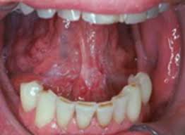 Image result for white cancer on tongue)