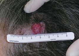Image result for Merkel Cell Carcinoma