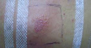 Image result for dermatitis contacta allergica