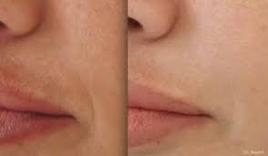 For the last year or so, i've been noticing that my nasolabial folds are getting deeper (that sounds dirty, doesn't it? Nasolabial Fold Filler Expert Doctors Injecting At Our Sydney Clinic