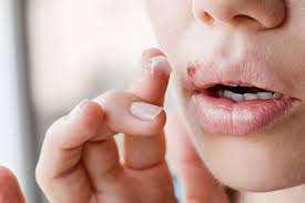 Wir informieren sie jetzt, woran sie herpes erkennen und wie sie sich vor einer ansteckung schützen können! Lippenherpes Ansteckung Wichtige Infos Volksversand Versandapotheke