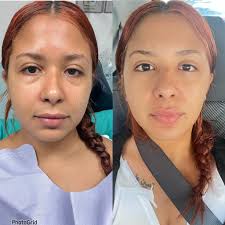 Free Program for Breast Implant Illness Recovery and Support