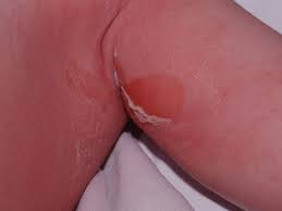 Staphylococcal Scalded Skin Syndrome Amboss