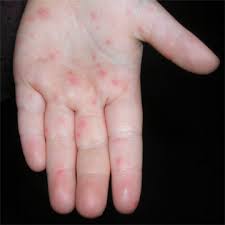 Hand, foot, and mouth diseasein children; Hand Foot And Mouth Disease Images Spring Valley Pediatrics