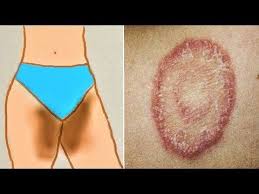 How To Treat Private Part Itching Fungal Infection Burning Yeast Infection Home Remed Yeast Infection Home Remedy Yeast Infection In Mouth Yeast Infection